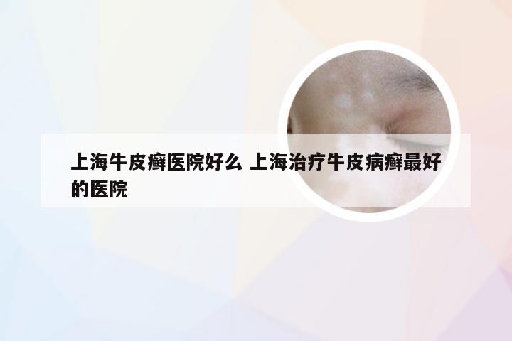 上海牛皮癣医院好么 上海治疗牛皮病癣最好的医院
