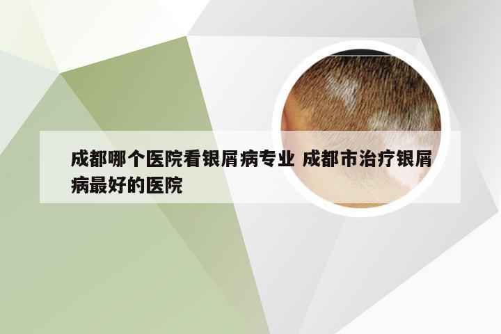 成都哪个医院看银屑病专业 成都市治疗银屑病最好的医院