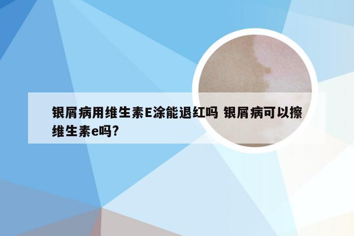 银屑病用维生素E涂能退红吗 银屑病可以擦维生素e吗?