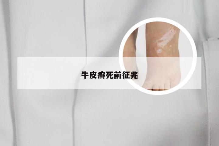 牛皮癣死前征兆