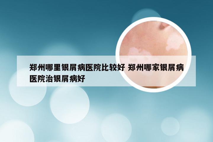 郑州哪里银屑病医院比较好 郑州哪家银屑病医院治银屑病好