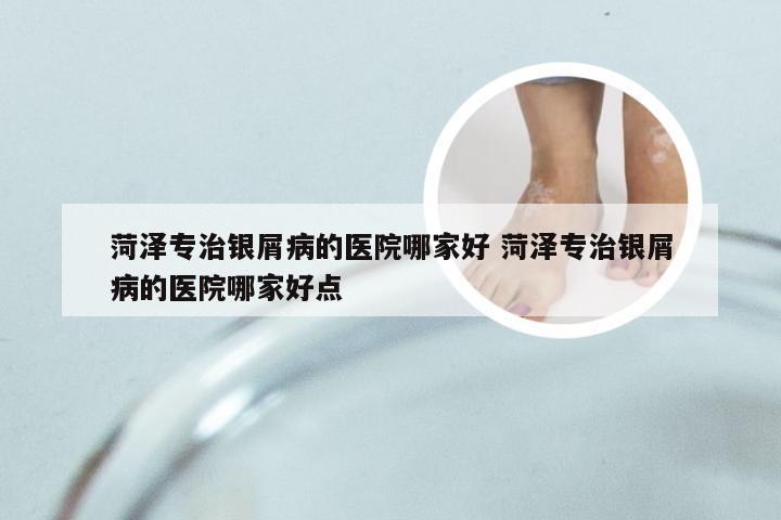 菏泽专治银屑病的医院哪家好 菏泽专治银屑病的医院哪家好点