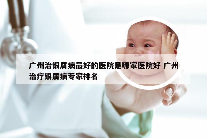 广州治银屑病最好的医院是哪家医院好 广州治疗银屑病专家排名