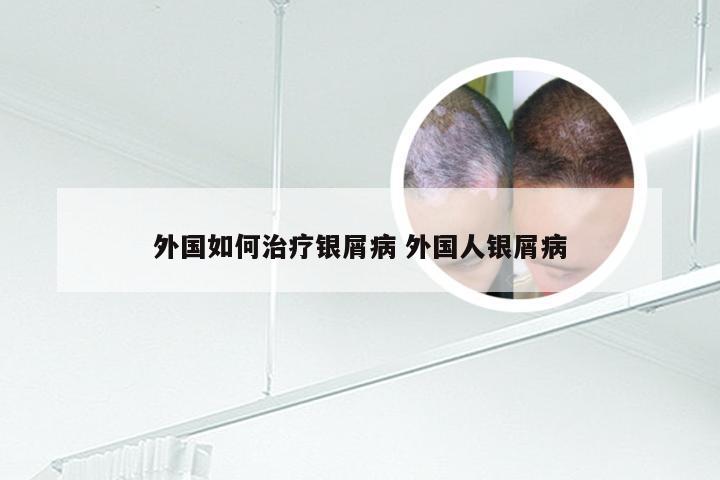 外国如何治疗银屑病 外国人银屑病