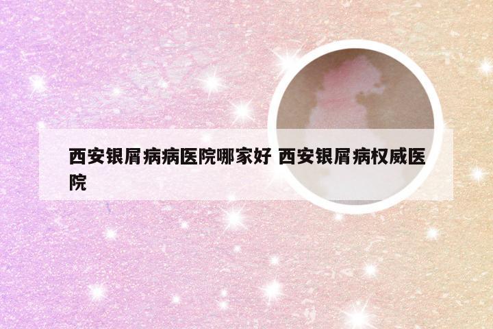 西安银屑病病医院哪家好 西安银屑病权威医院