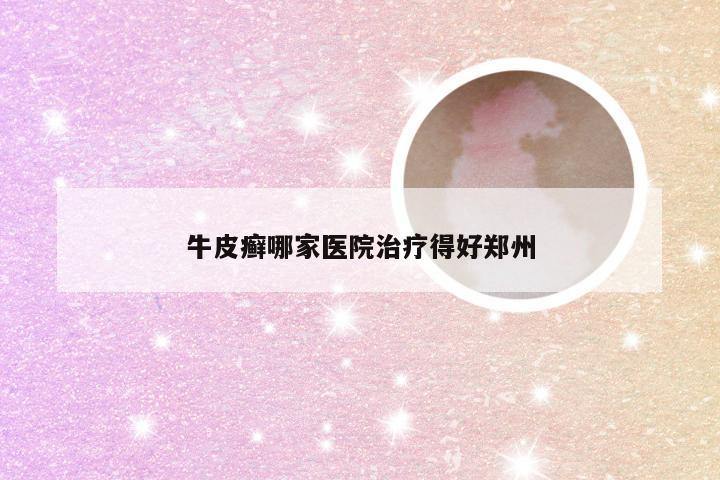 牛皮癣哪家医院治疗得好郑州