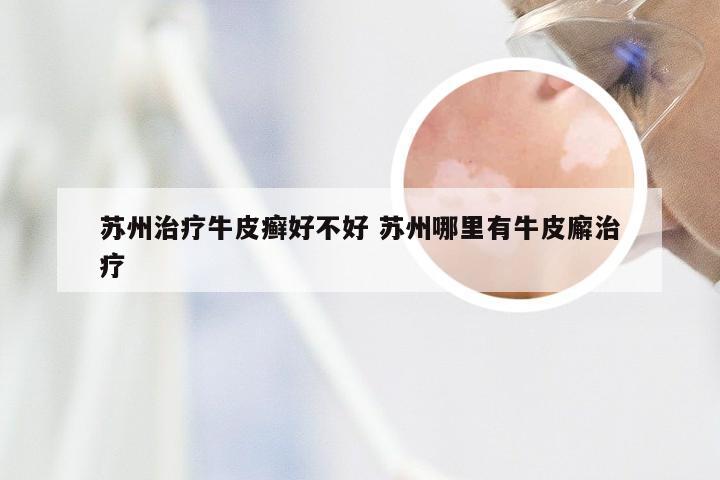 苏州治疗牛皮癣好不好 苏州哪里有牛皮廨治疗