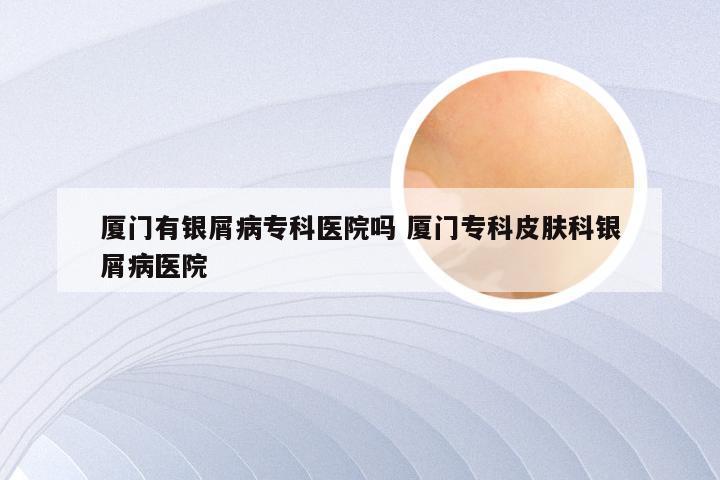 厦门有银屑病专科医院吗 厦门专科皮肤科银屑病医院
