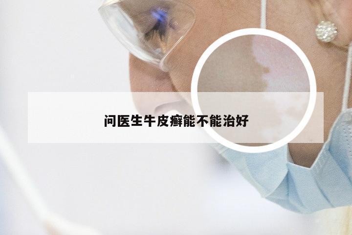 问医生牛皮癣能不能治好
