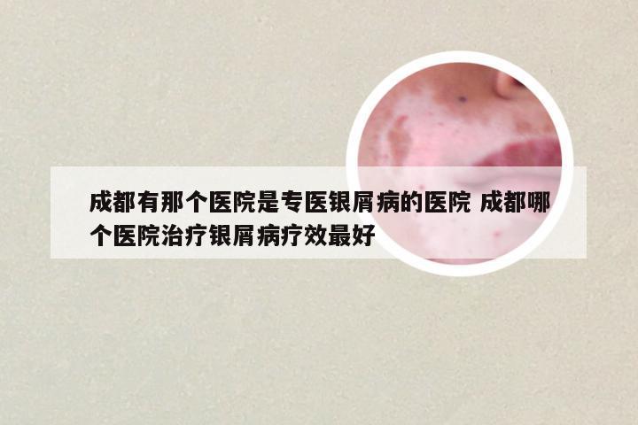 成都有那个医院是专医银屑病的医院 成都哪个医院治疗银屑病疗效最好