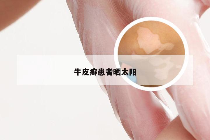 牛皮癣患者晒太阳