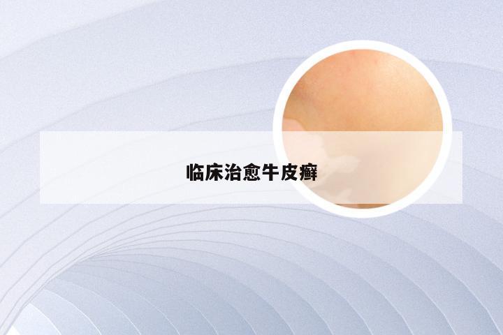 临床治愈牛皮癣