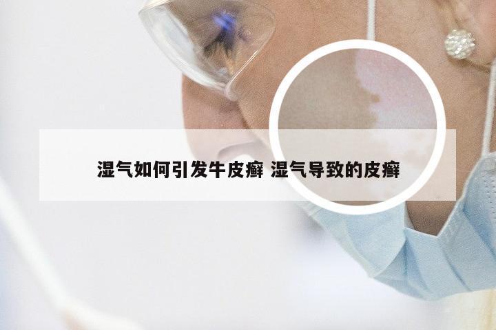 湿气如何引发牛皮癣 湿气导致的皮癣