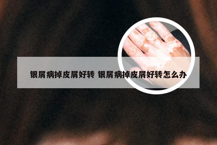 银屑病掉皮屑好转 银屑病掉皮屑好转怎么办