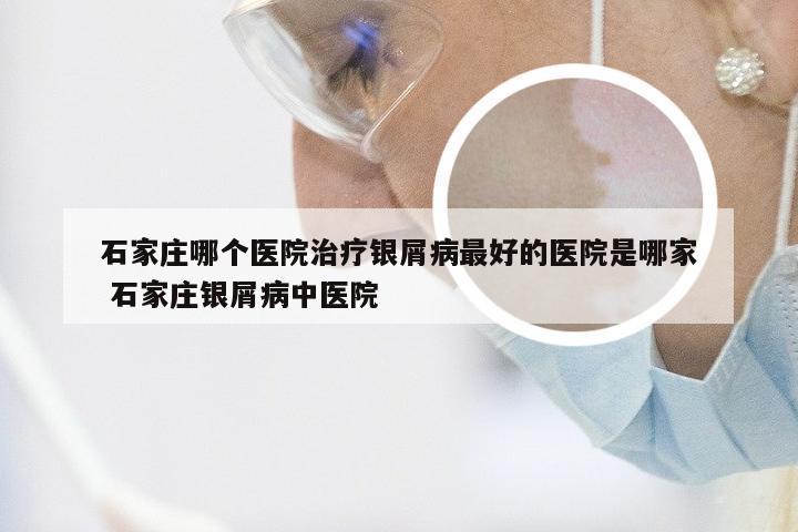 石家庄哪个医院治疗银屑病最好的医院是哪家 石家庄银屑病中医院