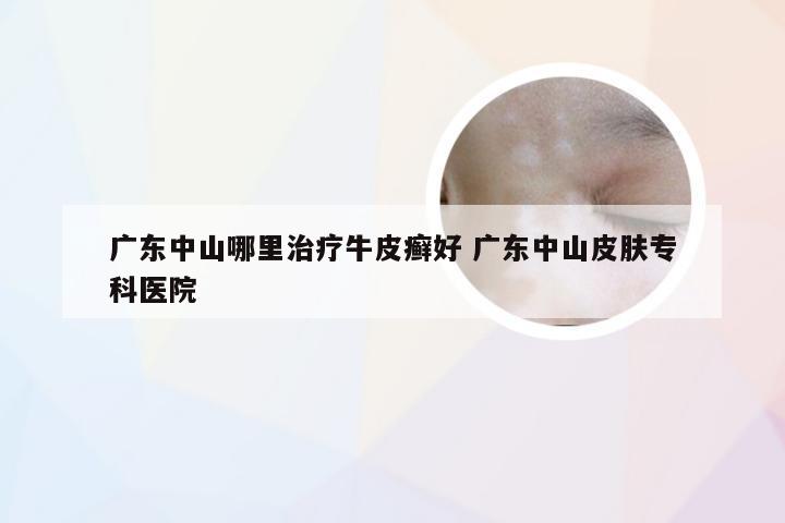 广东中山哪里治疗牛皮癣好 广东中山皮肤专科医院