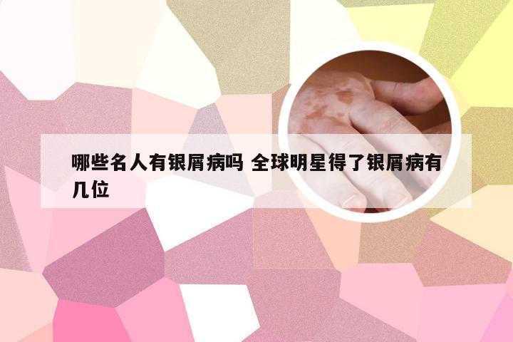 哪些名人有银屑病吗 全球明星得了银屑病有几位