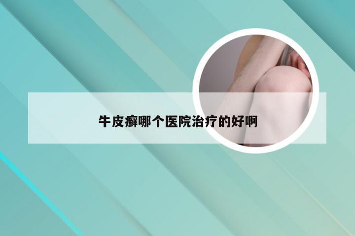 牛皮癣哪个医院治疗的好啊