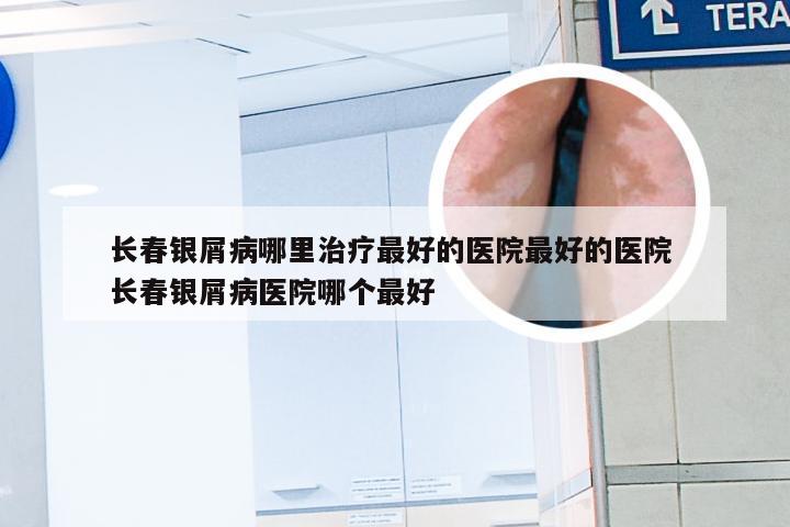 长春银屑病哪里治疗最好的医院最好的医院 长春银屑病医院哪个最好