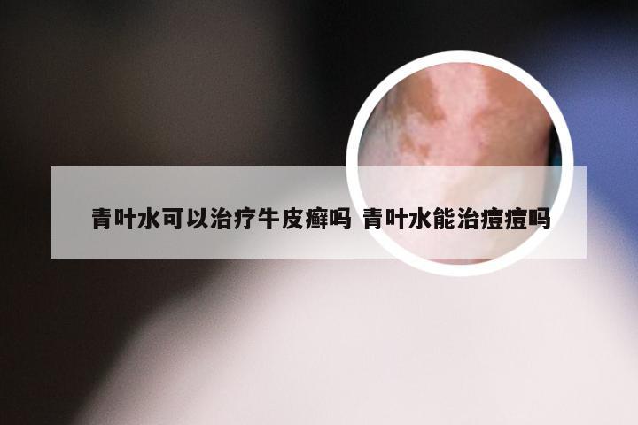 青叶水可以治疗牛皮癣吗 青叶水能治痘痘吗