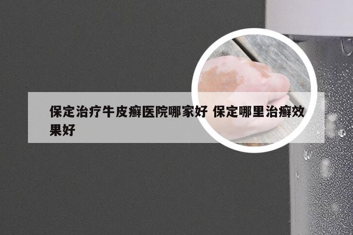 保定治疗牛皮癣医院哪家好 保定哪里治癣效果好