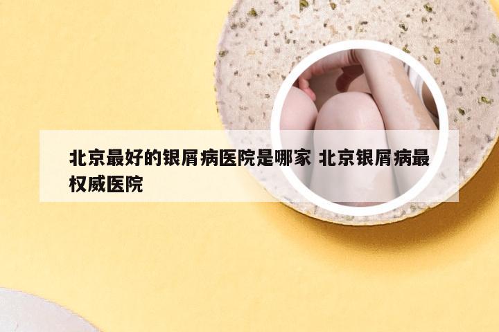 北京最好的银屑病医院是哪家 北京银屑病最权威医院