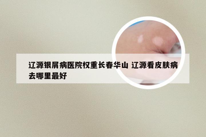 辽源银屑病医院权重长春华山 辽源看皮肤病去哪里最好