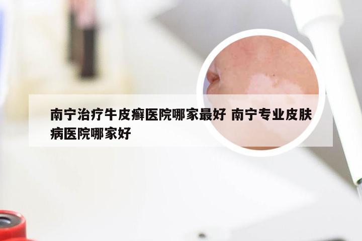 南宁治疗牛皮癣医院哪家最好 南宁专业皮肤病医院哪家好