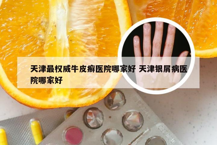 天津最权威牛皮癣医院哪家好 天津银屑病医院哪家好