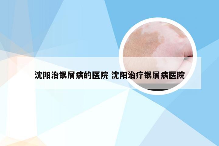 沈阳治银屑病的医院 沈阳治疗银屑病医院
