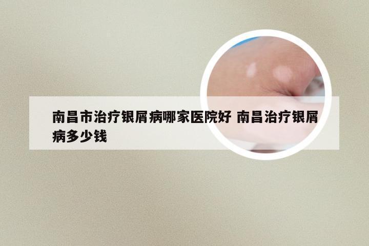 南昌市治疗银屑病哪家医院好 南昌治疗银屑病多少钱
