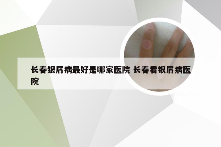 长春银屑病最好是哪家医院 长春看银屑病医院