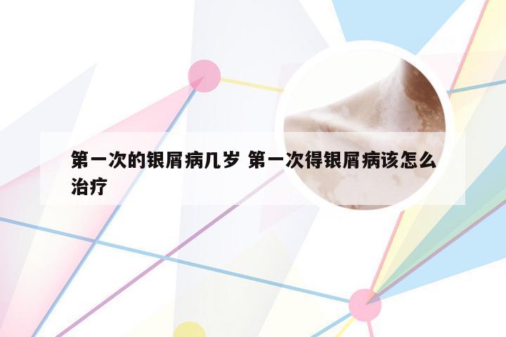 第一次的银屑病几岁 第一次得银屑病该怎么治疗