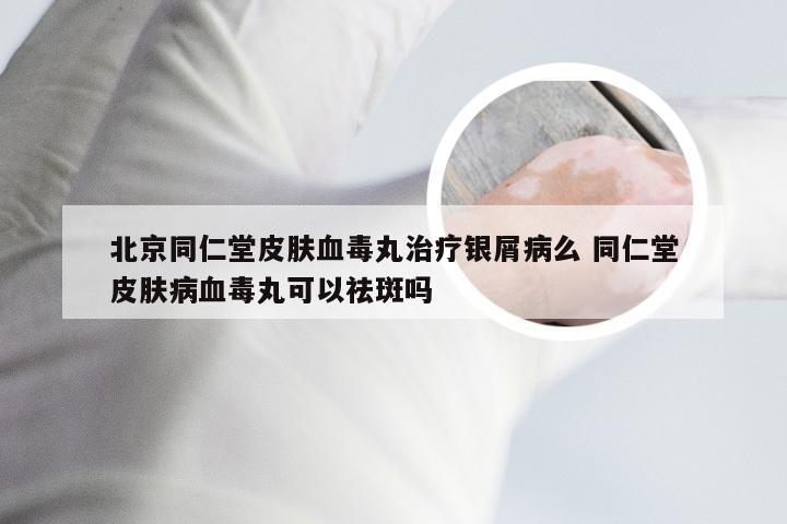 北京同仁堂皮肤血毒丸治疗银屑病么 同仁堂皮肤病血毒丸可以祛斑吗
