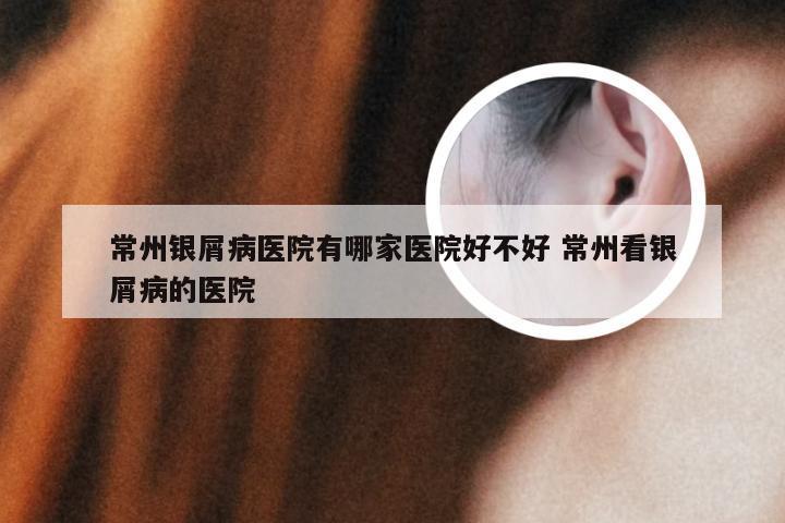 常州银屑病医院有哪家医院好不好 常州看银屑病的医院