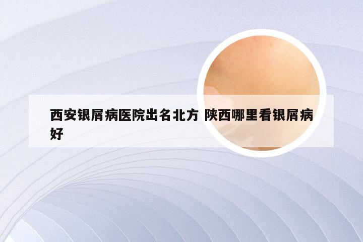 西安银屑病医院出名北方 陕西哪里看银屑病好