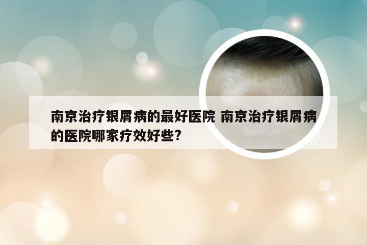南京治疗银屑病的最好医院 南京治疗银屑病的医院哪家疗效好些?