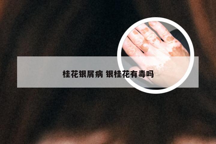 桂花银屑病 银桂花有毒吗