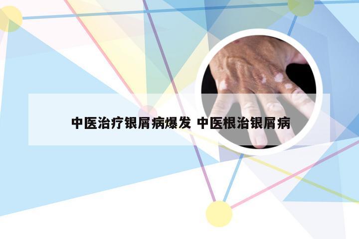 中医治疗银屑病爆发 中医根治银屑病
