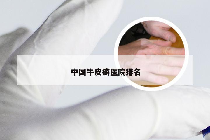 中国牛皮癣医院排名