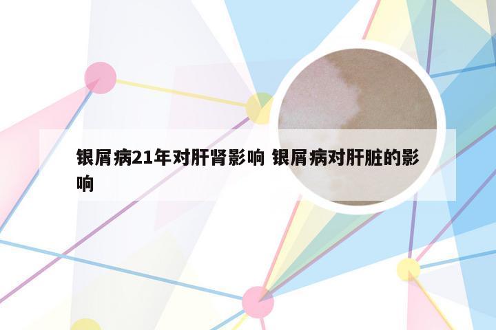 银屑病21年对肝肾影响 银屑病对肝脏的影响