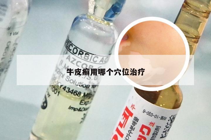 牛皮癣用哪个穴位治疗