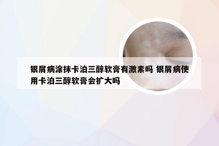 银屑病涂抹卡泊三醇软膏有激素吗 银屑病使用卡泊三醇软膏会扩大吗