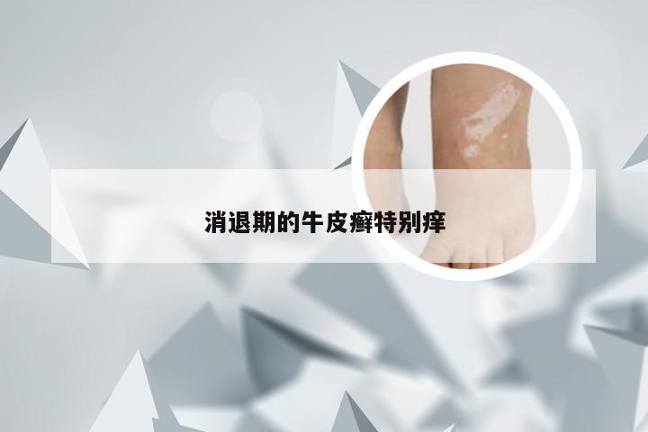 消退期的牛皮癣特别痒