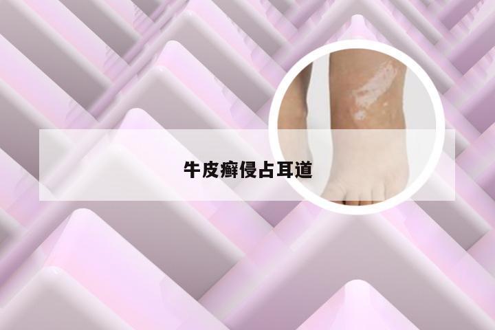 牛皮癣侵占耳道