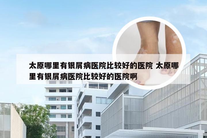 太原哪里有银屑病医院比较好的医院 太原哪里有银屑病医院比较好的医院啊