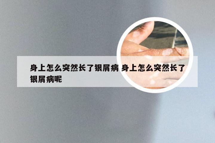 身上怎么突然长了银屑病 身上怎么突然长了银屑病呢