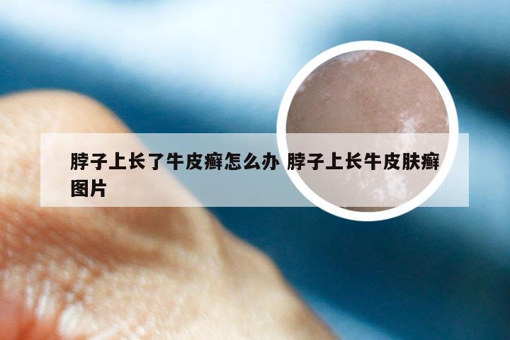脖子上长了牛皮癣怎么办 脖子上长牛皮肤癣图片