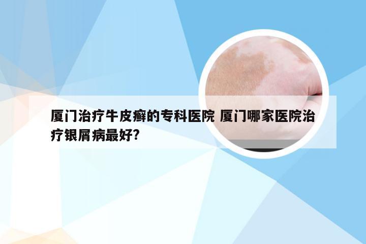厦门治疗牛皮癣的专科医院 厦门哪家医院治疗银屑病最好?