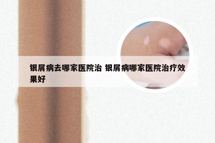 银屑病去哪家医院治 银屑病哪家医院治疗效果好